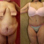 Tummy Tuck (Abdominoplasty) Plus Size Before & After Patient #5874