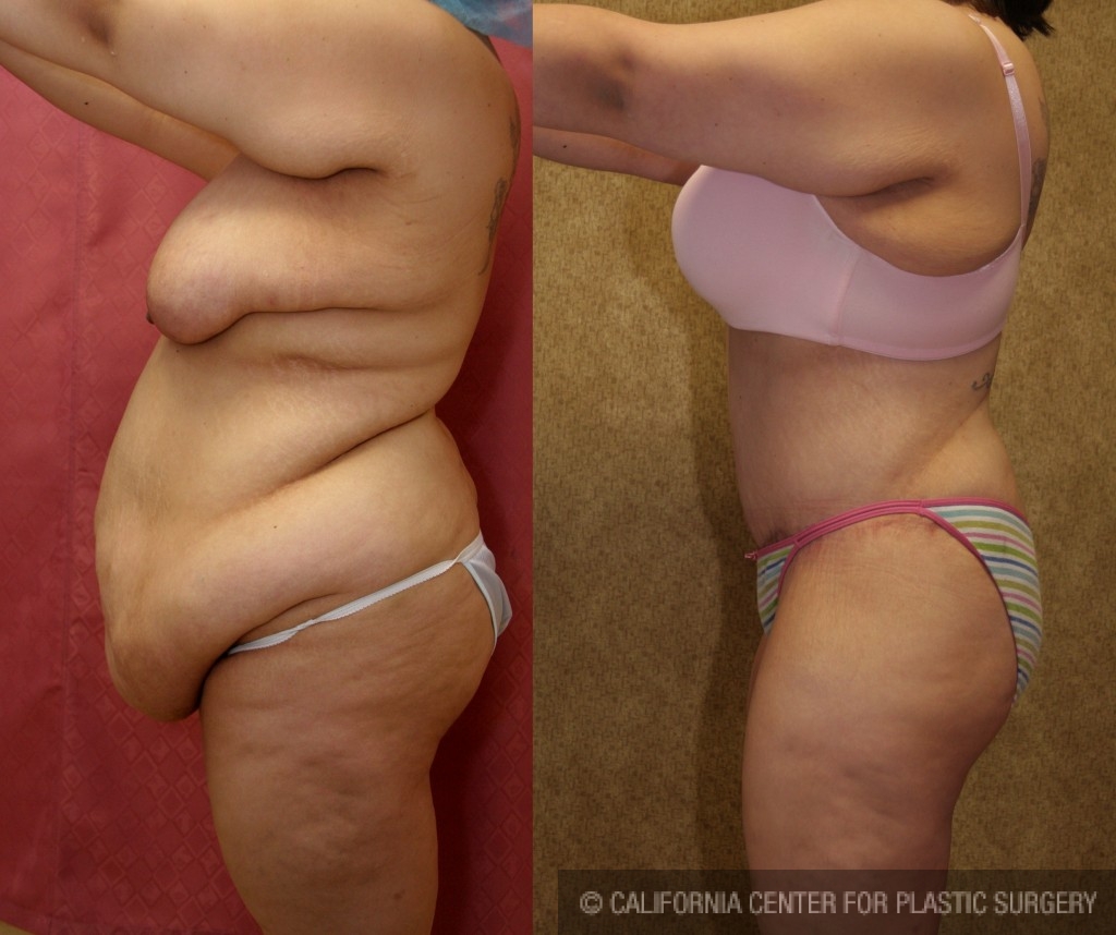 Tummy Tuck (Abdominoplasty) Plus Size Before & After Patient #5874