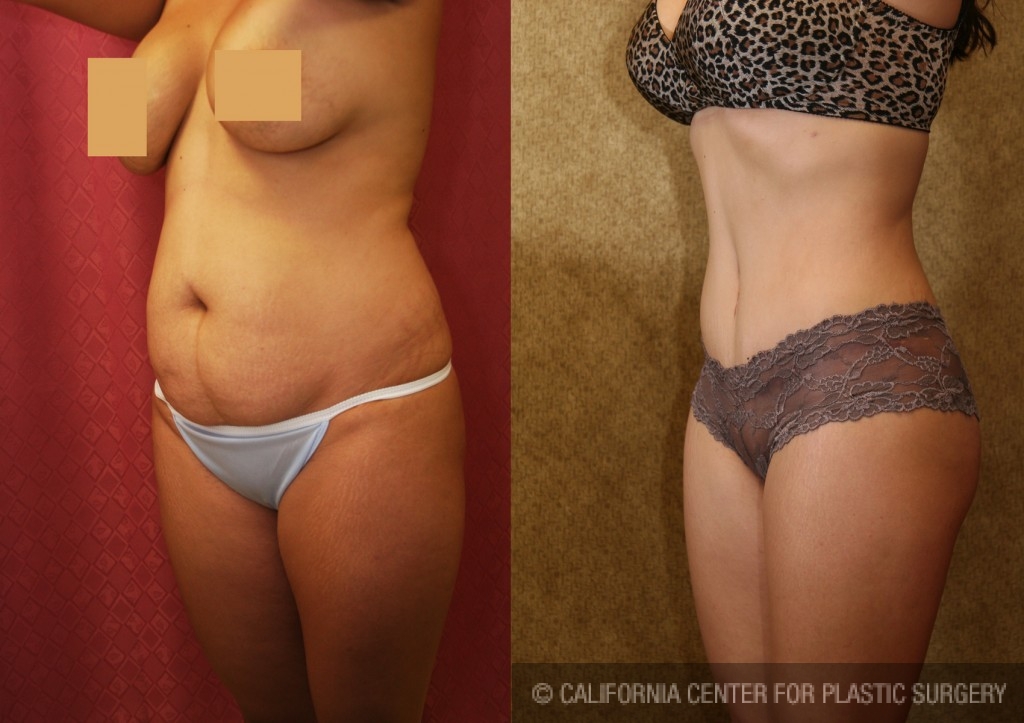 Tummy Tuck (Abdominoplasty) Small Size Before & After Patient #5726