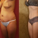 Tummy Tuck (Abdominoplasty) Small Size Before & After Patient #5726