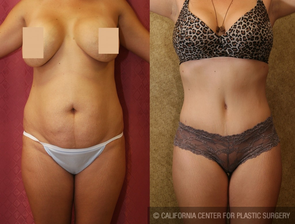 Tummy Tuck (Abdominoplasty) Small Size Before & After Patient #5726