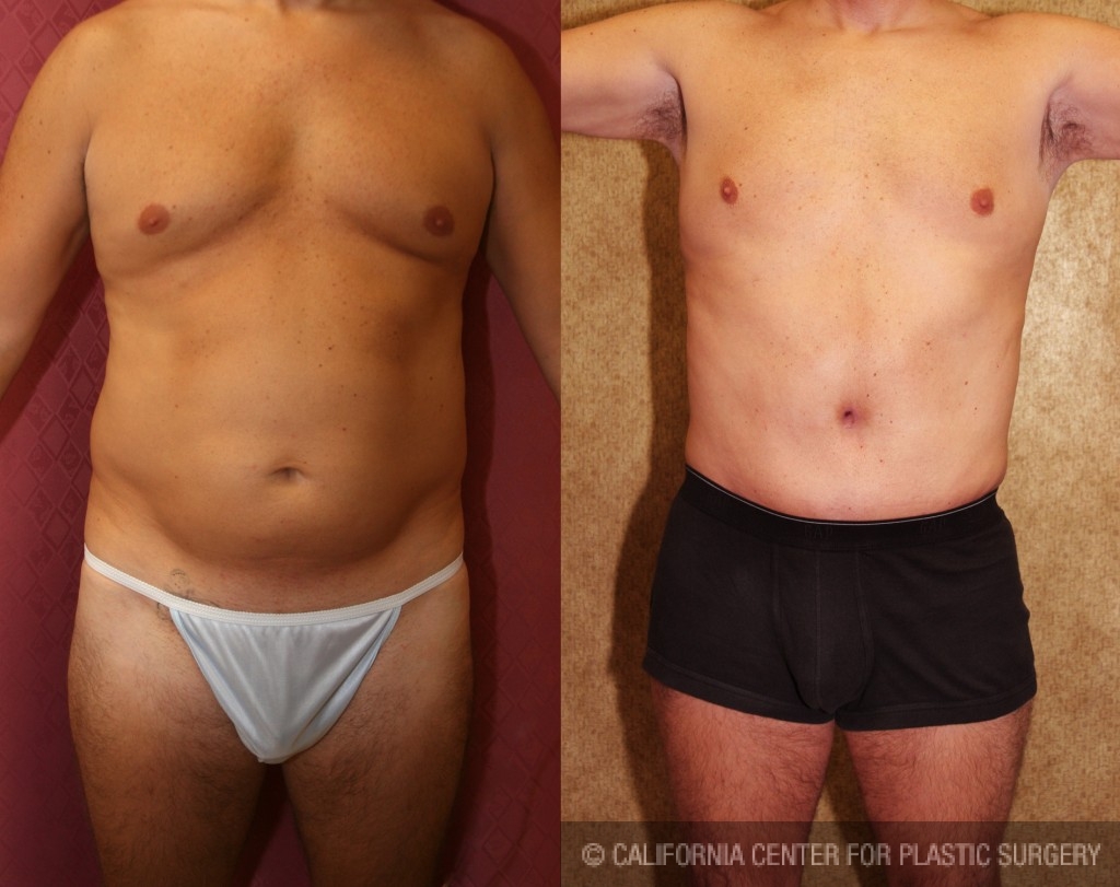 Male Tummy Tuck Before & After Patient #6014