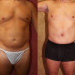 Male Tummy Tuck (abdominoplasty) Before & After Patient #6014