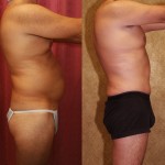 Male Tummy Tuck (abdominoplasty) Before & After Patient #6014