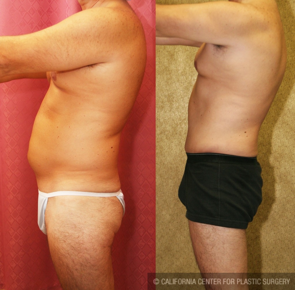 Male Tummy Tuck (abdominoplasty) Before & After Patient #6014