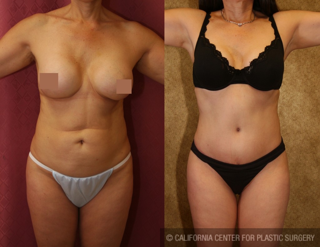 Tummy Tuck (Abdominoplasty) Medium Size Before & After Patient #5831