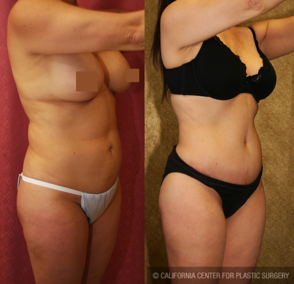 Tummy Tuck (Abdominoplasty) Medium Size Before & After Patient #5831