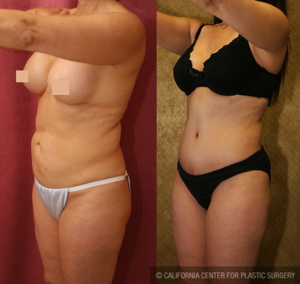 Tummy Tuck (Abdominoplasty) Medium Size Before & After Patient #5831