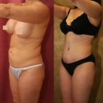 Tummy Tuck (Abdominoplasty) Medium Size Before & After Patient #5831