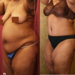 African American Tummy Tuck (Abdominoplasty) Before & After Patient #5944