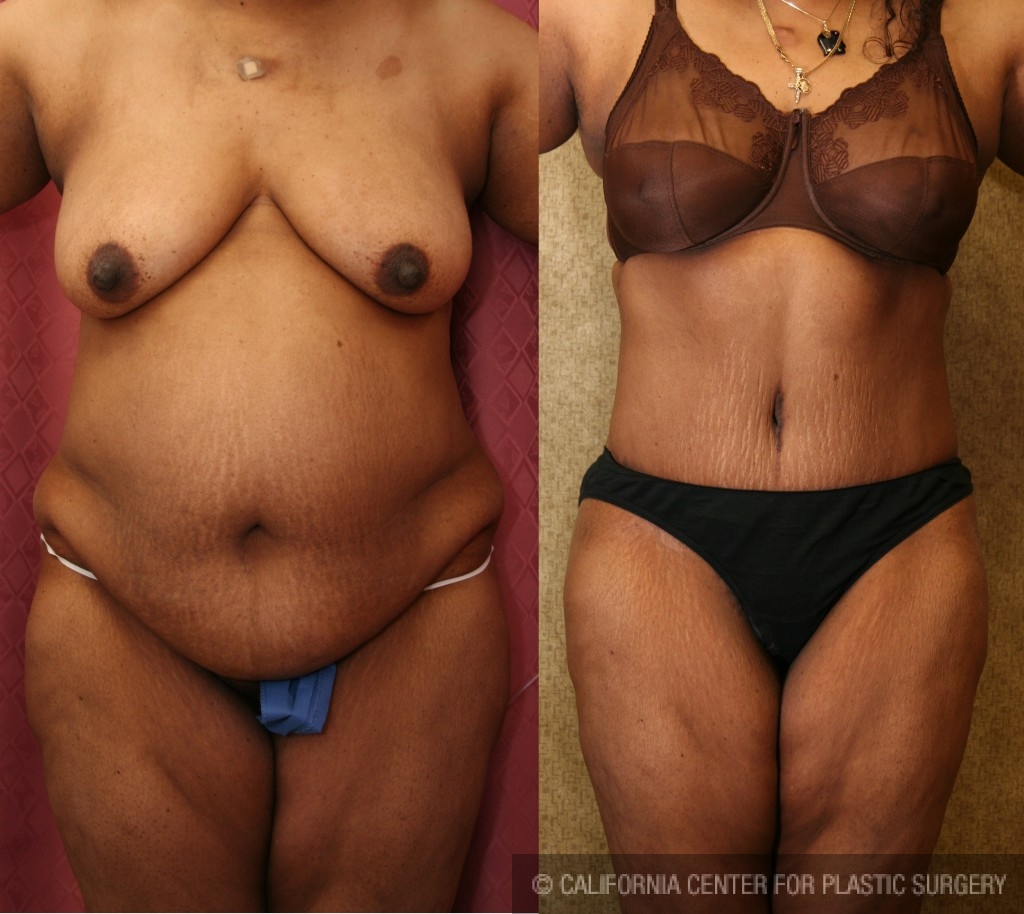 African American Tummy Tuck (Abdominoplasty) Before & After Patient #5944