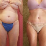 Tummy Tuck (Abdominoplasty) Medium Size Before & After Patient #5773