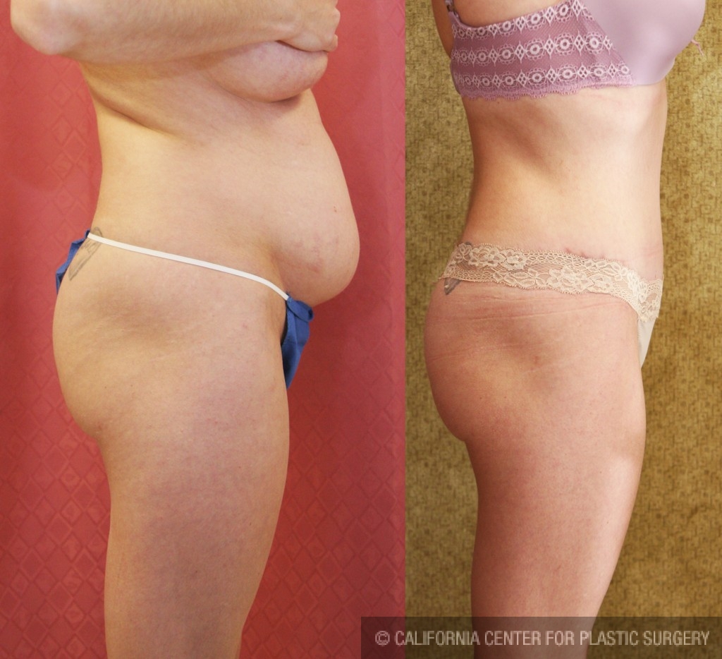 Tummy Tuck (Abdominoplasty) Medium Size Before & After Patient #5773