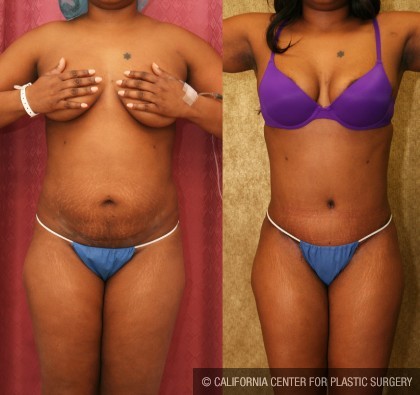 African American Tummy Tuck (Abdominoplasty) Before & After Patient #5933