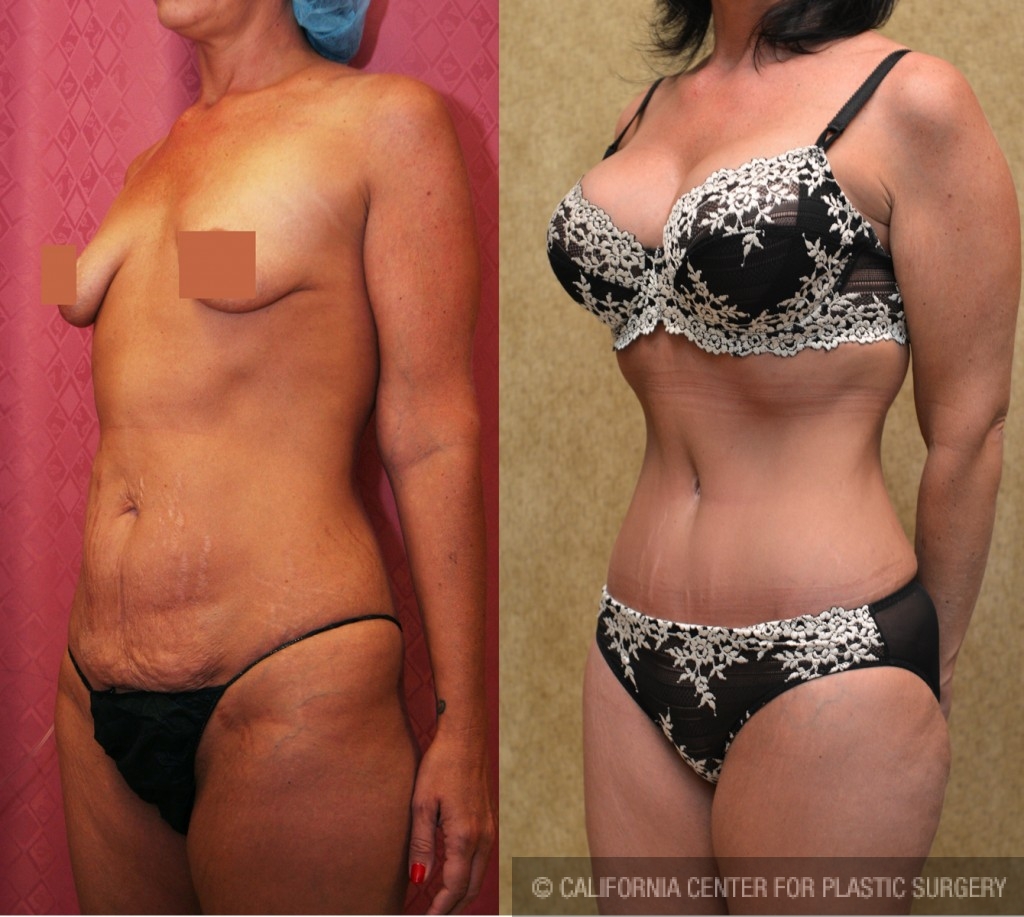 Tummy Tuck (Abdominoplasty) Small Size Before & After Patient #5732
