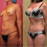 Tummy Tuck (Abdominoplasty) Small Size Before & After Patient #5732