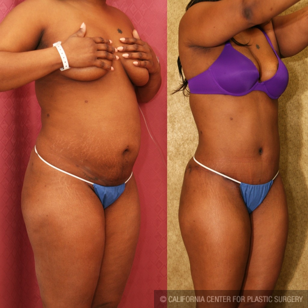 amatuer wife with tummy tuck scar