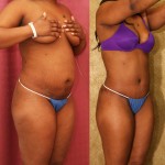 African American Tummy Tuck (Abdominoplasty) Before & After Patient #5933