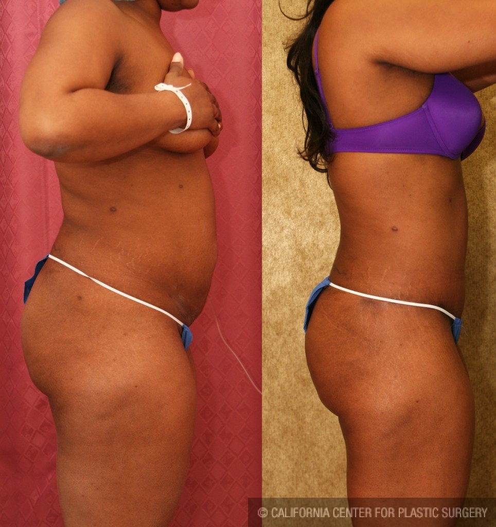 African American Tummy Tuck (Abdominoplasty) Before & After Patient #5933