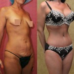 Mommy Makeover Before & After Patient #5979