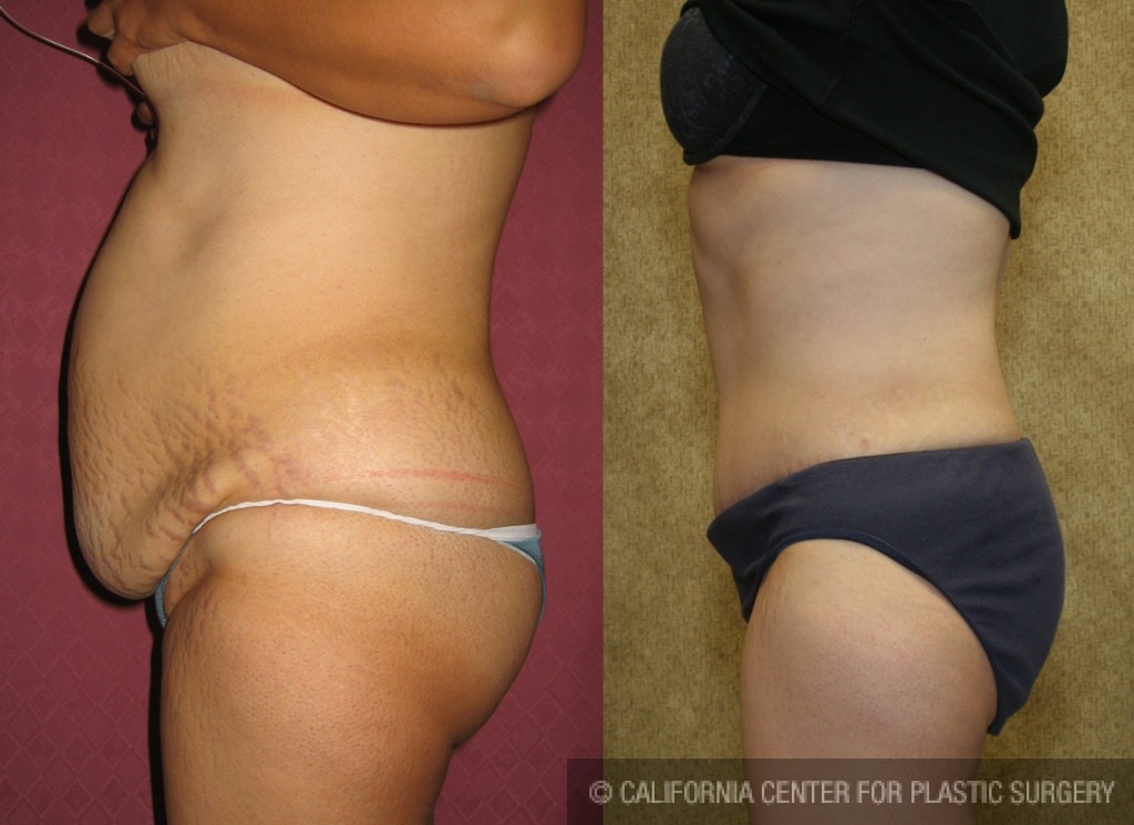 Tummy Tuck (Abdominoplasty) Medium Size Before & After Patient #5869
