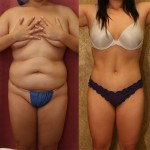 Tummy Tuck (Abdominoplasty) Medium Size Before & After Patient #5798