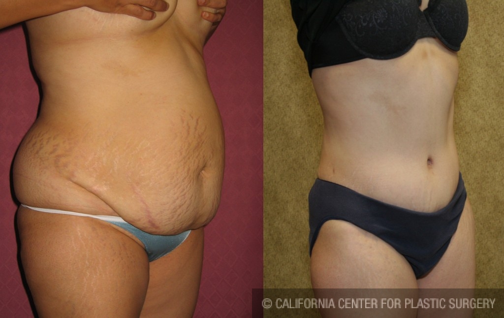 Tummy Tuck (Abdominoplasty) Medium Size Before & After Patient #5869