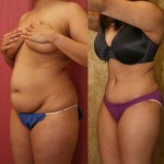 Tummy Tuck (Abdominoplasty) Small Size Before & After Patient #5745