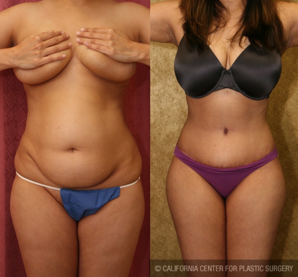 Patient #5745 Tummy Tuck (Abdominoplasty) Small Size Before and