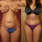 Tummy Tuck (Abdominoplasty) Small Size Before & After Patient #5745