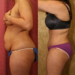 Tummy Tuck (Abdominoplasty) Small Size Before & After Patient #5745