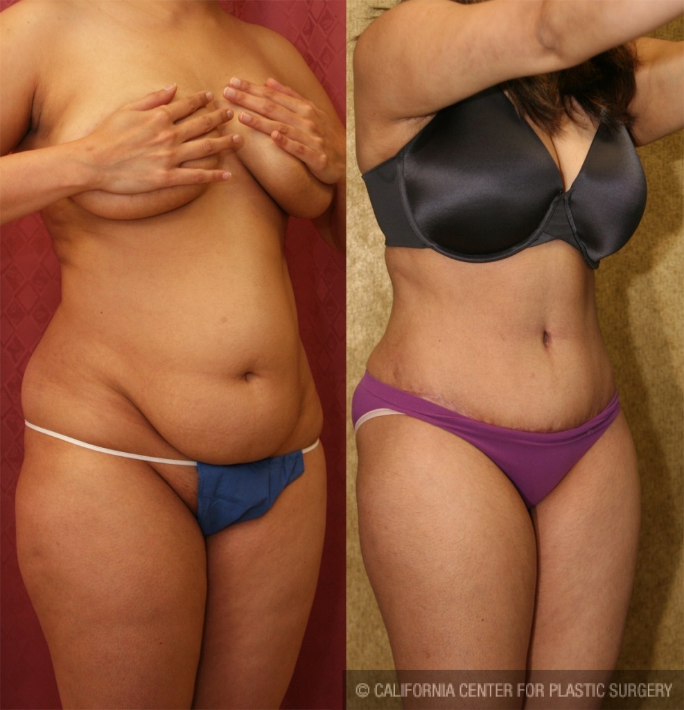 Tummy Tuck (Abdominoplasty) Small Size Before & After Patient #5745