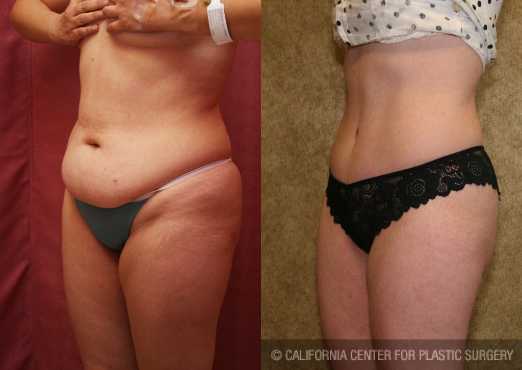 Tummy Tuck (Abdominoplasty) Small Size Before & After Patient #5737