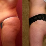 Tummy Tuck (Abdominoplasty) Small Size Before & After Patient #5737