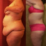Tummy Tuck (Abdominoplasty) Plus Size Before & After Patient #5888
