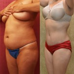 Tummy Tuck (Abdominoplasty) Medium Size Before & After Patient #5808