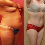 Tummy Tuck (Abdominoplasty) Medium Size Before & After Patient #5808