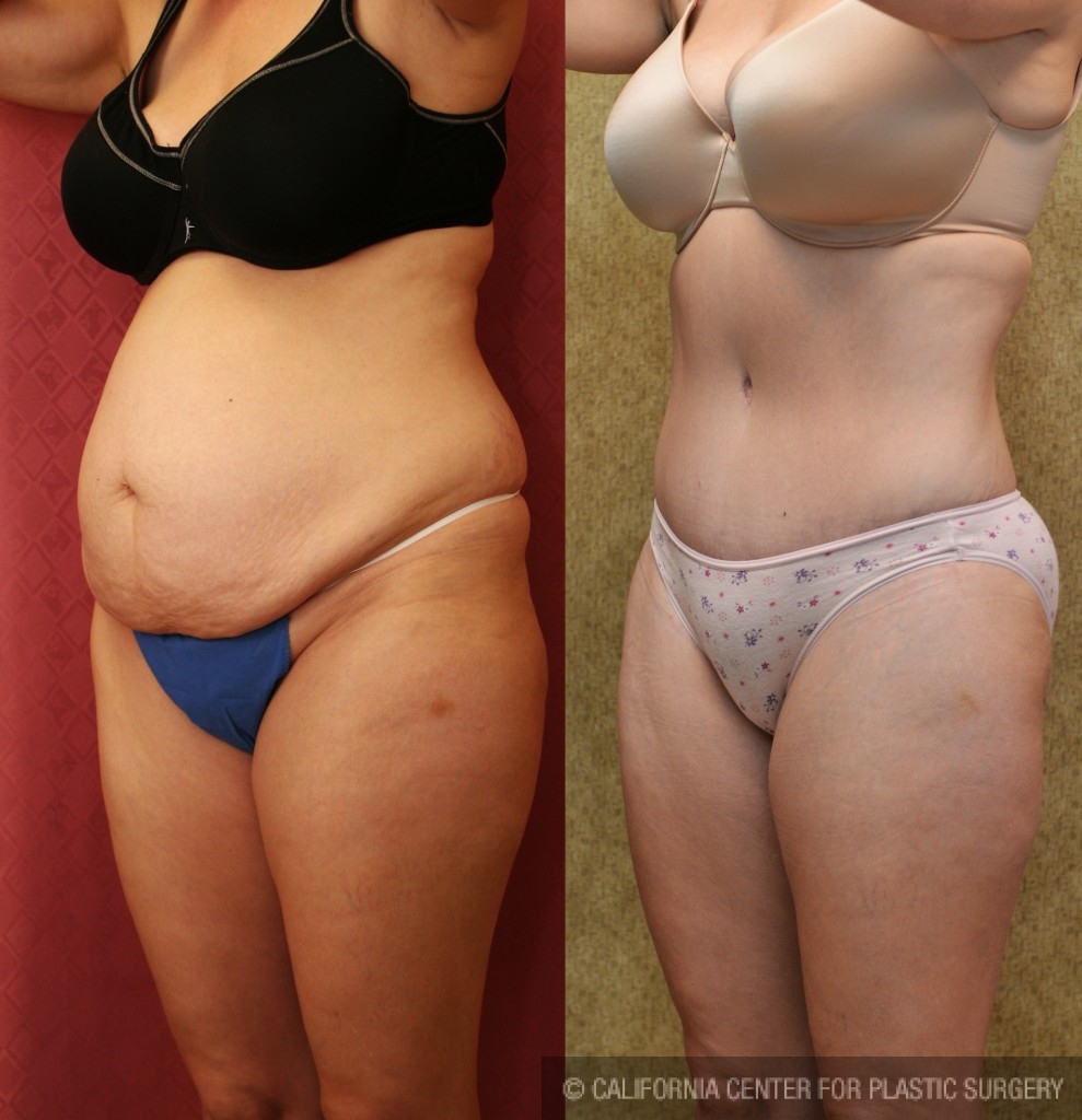 Tummy Tuck (Abdominoplasty) Medium Size Before & After Patient #5865