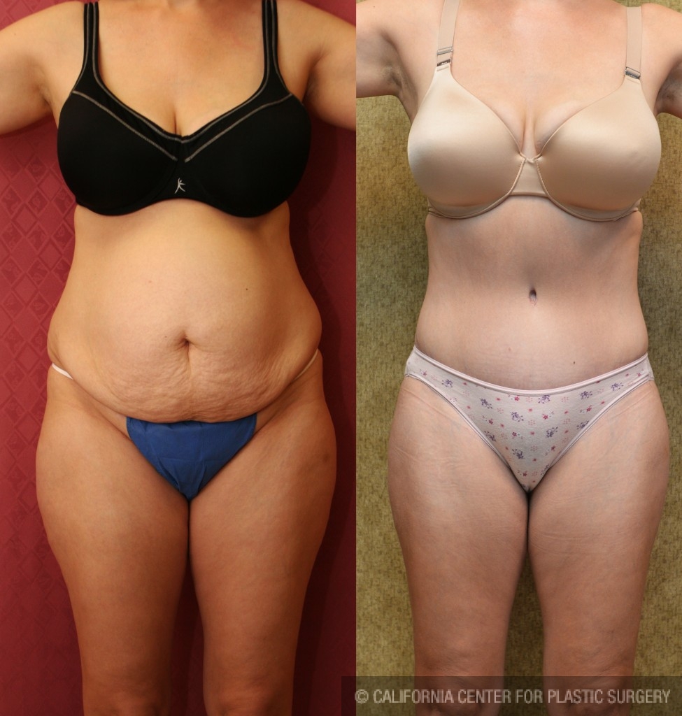 Tummy Tuck (Abdominoplasty) Medium Size Before & After Patient #5865