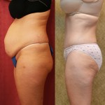 Tummy Tuck (Abdominoplasty) Medium Size Before & After Patient #5865