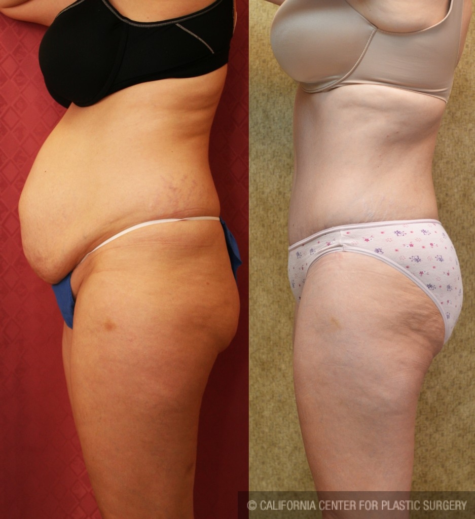 Tummy Tuck (Abdominoplasty) Medium Size Before & After Patient #5865