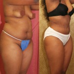 African American Tummy Tuck (Abdominoplasty) Before & After Patient #5953
