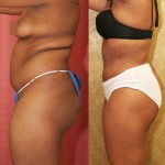 African American Tummy Tuck (Abdominoplasty) Before & After Patient #5953