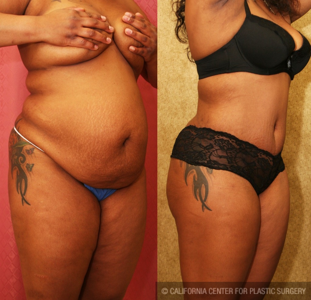 African American Tummy Tuck (Abdominoplasty) Before & After Patient #5929