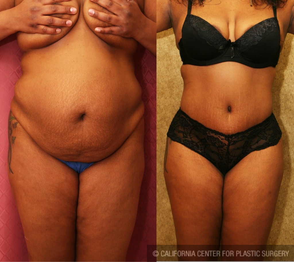 African American Tummy Tuck (Abdominoplasty) Before & After Patient #5929