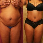 African American Tummy Tuck (Abdominoplasty) Before & After Patient #5929
