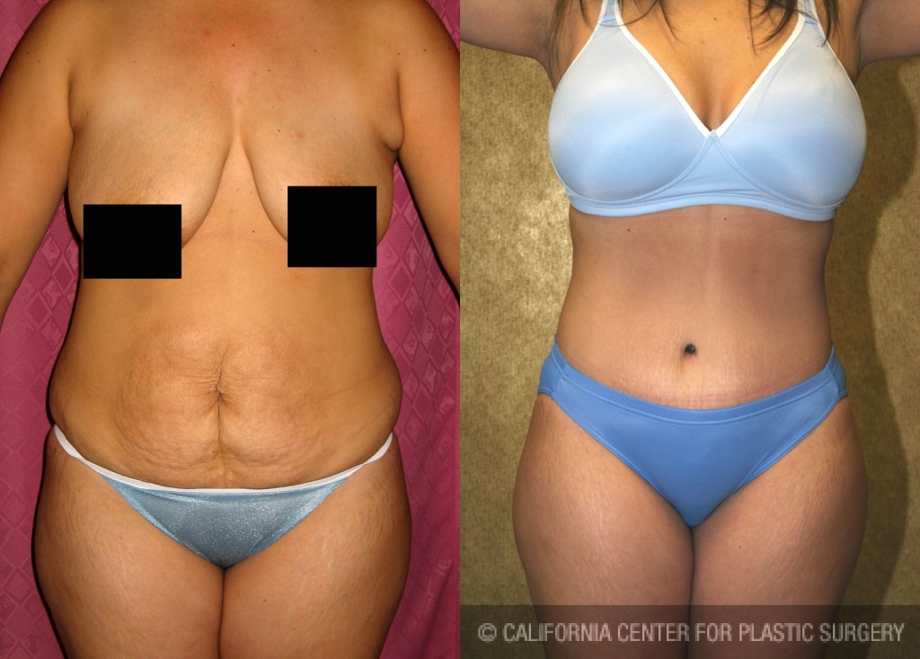 Tummy Tuck (Abdominoplasty) Small Size Before & After Patient #5990