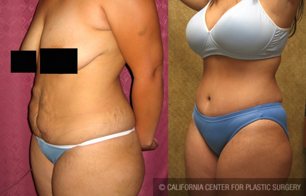 Tummy Tuck (Abdominoplasty) Small Size Before & After Patient #5990