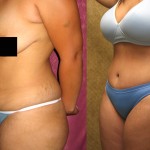 Tummy Tuck (Abdominoplasty) Small Size Before & After Patient #5990