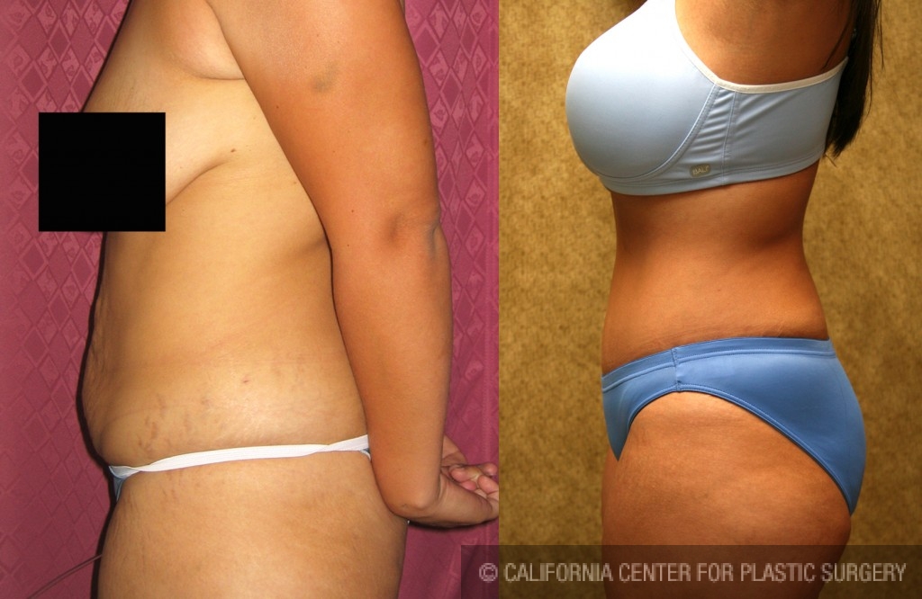 Tummy Tuck (Abdominoplasty) Small Size Before & After Patient #5990
